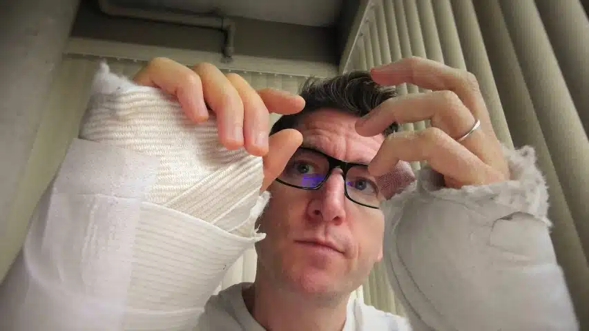 arms in casts