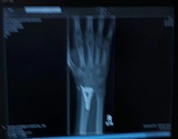 arm-bones X-ray